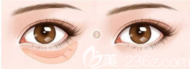 祛眼袋前后效果對(duì)比圖