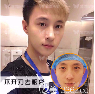 北京紫潔醫(yī)美不開刀祛眼袋案例