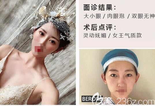 阿拉蕾美眼綜合