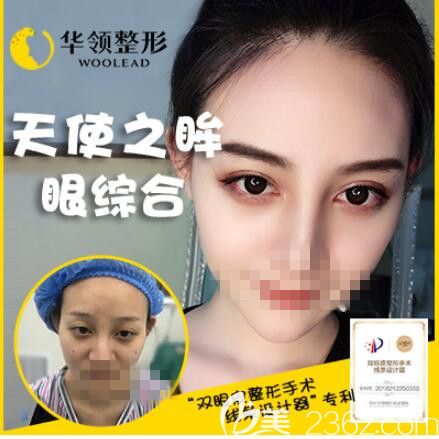 天使之眸眼綜合 