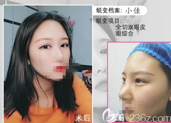 駱氏芭比眼綜合