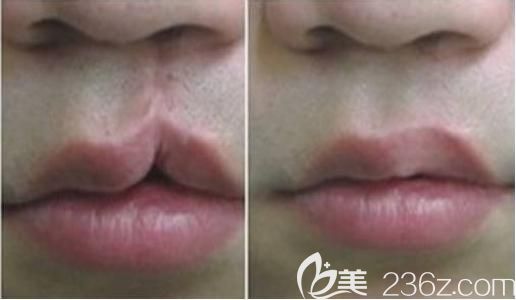 唇腭裂修復(fù)效果