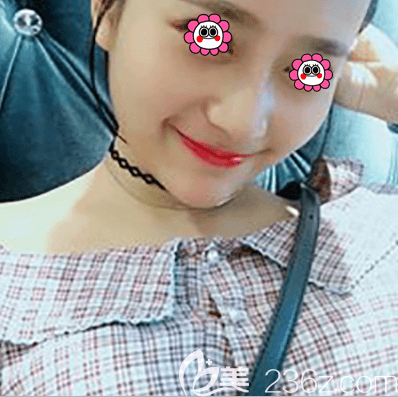 我在北京紫潔醫(yī)美做鼻綜合第15天效果 我在北京紫潔醫(yī)美做鼻綜合第15天效果