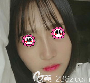 對(duì)于鼻綜合包括哪些項(xiàng)目我做了了解后就找北京紫潔劉文峰做了手術(shù)
