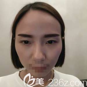 鄭州激光祛斑醫(yī)院有哪些?聽朋友推薦去鄭州華領(lǐng)體驗(yàn)了一把M22王者之心真是祛斑又嫩膚