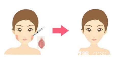 咬肌大的原因，只需要通過注射瘦臉