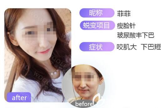 鄭州華領瘦臉注射前后對比