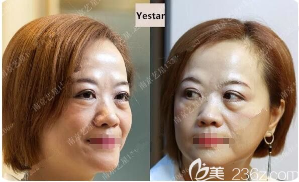 術(shù)前眼袋厚重法令紋明顯 術(shù)前眼袋厚重法令紋明顯