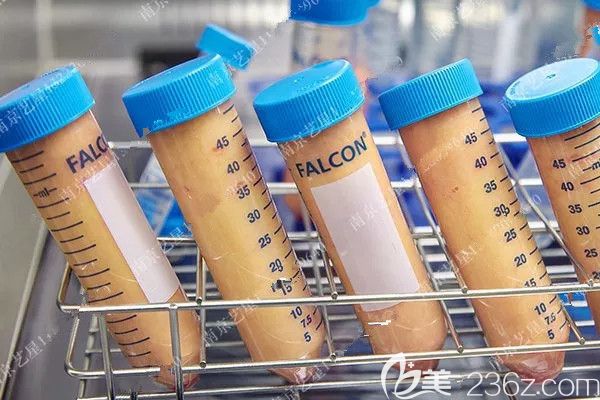 面部脂肪填充中抽吸提純過的脂肪 面部脂肪填充中抽吸提純過的脂肪