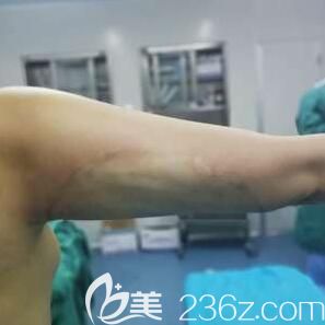 做水動力手臂吸脂術(shù)前照 做水動力手臂吸脂術(shù)前照