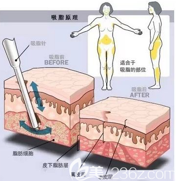 吸脂大小腿示意圖