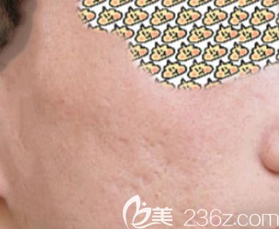 呼和浩特祛痘坑哪家醫(yī)院好?請(qǐng)看我在呼市京美整形激光點(diǎn)陣祛痘坑費(fèi)用和5次點(diǎn)陣激光去痘坑效果圖 