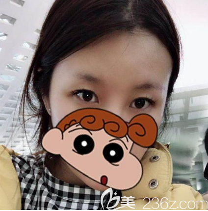 在深圳鵬程醫(yī)院做雙眼皮術(shù)前照片 在深圳鵬程醫(yī)院做雙眼皮術(shù)前照片