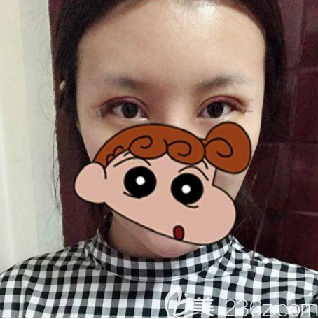 全切雙眼皮術(shù)后四天恢復(fù)效果圖 全切雙眼皮術(shù)后四天恢復(fù)效果圖