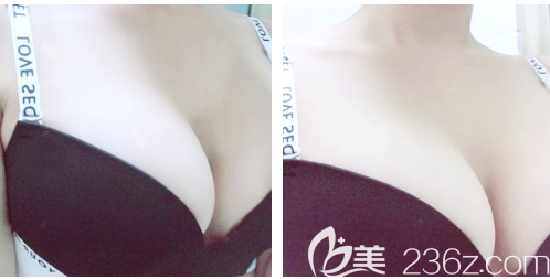 深圳麗港麗格做隆胸效果怎么樣 深圳麗港麗格做隆胸效果怎么樣