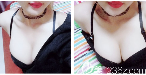 找深圳麗港麗格謝俊院長做曼托假體隆胸兩個(gè)月了,無論胸型還是手感都非常真實(shí)自然