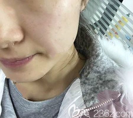 在<!--<i data=20240703-sp></i>-->整形醫(yī)院找周玲主任做激光祛斑術(shù)后第2天 在<!--<i data=20240703-sp></i>-->整形醫(yī)院找周玲主任做激光祛斑術(shù)后第2天