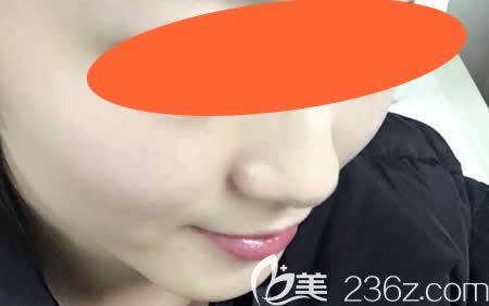 在<!--<i data=20240703-sp></i>-->整形醫(yī)院找周玲主任做激光祛斑術(shù)后第14天 在<!--<i data=20240703-sp></i>-->整形醫(yī)院找周玲主任做激光祛斑術(shù)后第14天