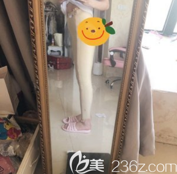 宋華敬大腿吸脂術后5天