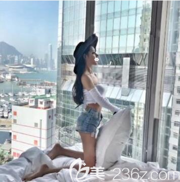 成都西區(qū)醫(yī)院大腿吸脂術后一個月恢復照片