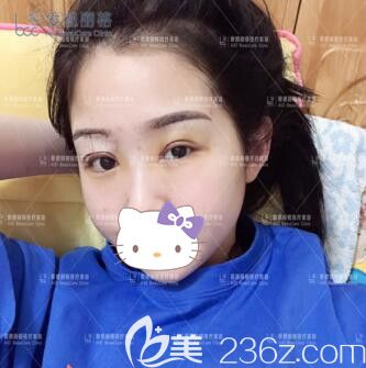 在大連愛(ài)德麗格做雙眼皮修復(fù)術(shù)后1天 在大連愛(ài)德麗格做雙眼皮修復(fù)術(shù)后1天