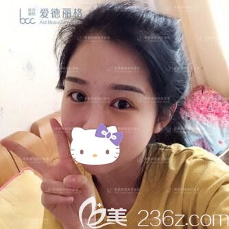 找愛(ài)德麗格劉志剛做雙眼皮修復(fù)術(shù)后5天效果 找愛(ài)德麗格劉志剛做雙眼皮修復(fù)術(shù)后5天效果