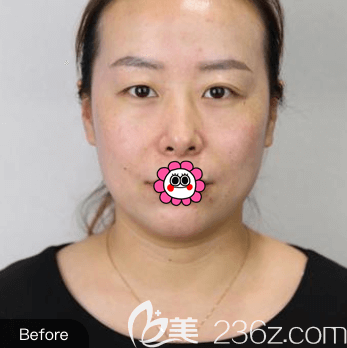 我在北京惠合嘉美做眼綜合前樣子 我在北京惠合嘉美做眼綜合前樣子