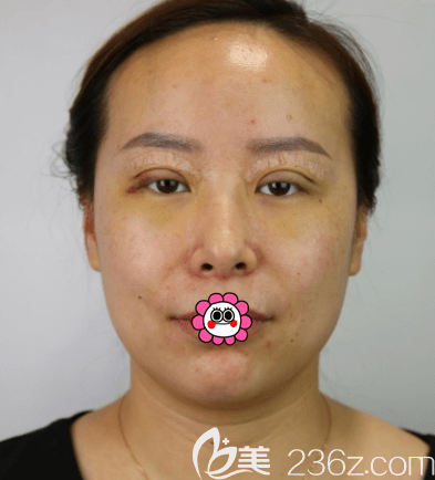 <!--<i data=20240703-sp></i>-->醫(yī)生給我做眼綜合第3天樣子 <!--<i data=20240703-sp></i>-->醫(yī)生給我做眼綜合第3天樣子