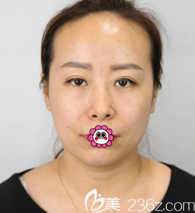 在北京惠合嘉美做眼綜合第26天樣子 在北京惠合嘉美做眼綜合第26天樣子