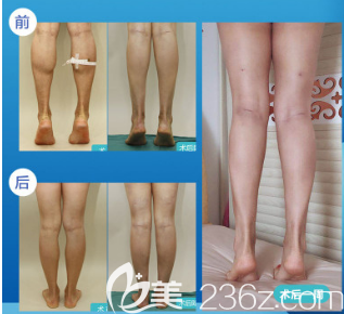 德州天宏醫(yī)療美容大腿吸脂案例