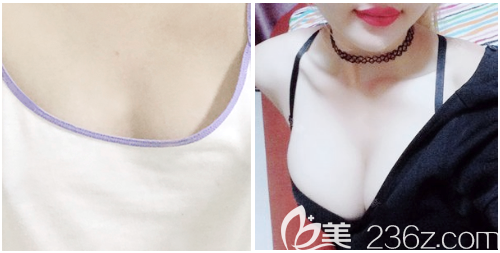 深圳麗港麗格謝俊隆胸案例前后對(duì)比圖 深圳麗港麗格謝俊隆胸案例前后對(duì)比圖