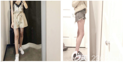 佛山抽脂哪家好？看佛山夢(mèng)露大腿吸脂案例