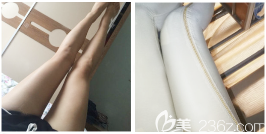 大腿吸脂術(shù)后7天恢復(fù)過(guò)程圖