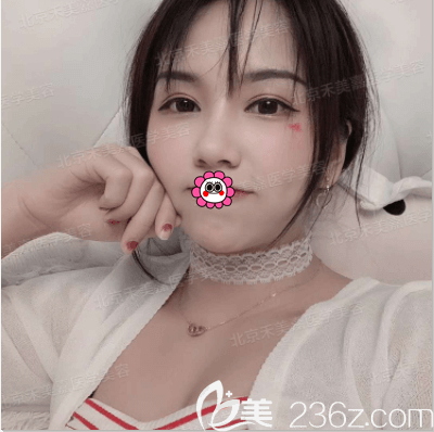 任學(xué)會(huì)醫(yī)生給我做真C自體脂肪活力豐胸第7天效果