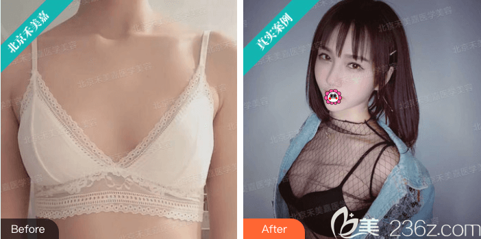 北京禾美嘉任學(xué)會(huì)真C自體脂肪活力豐胸案例