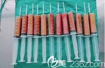 韓國安敬天吸脂真人案例