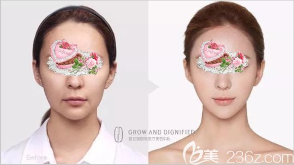 長(zhǎng)春姬安娣整形全面部自體脂肪填充案例效果圖