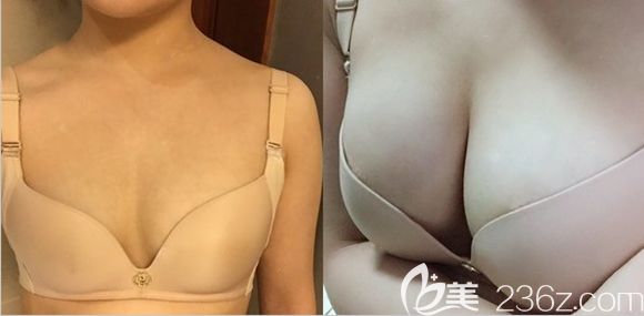 長(zhǎng)春姬安娣整形自體脂肪豐胸案例效果圖