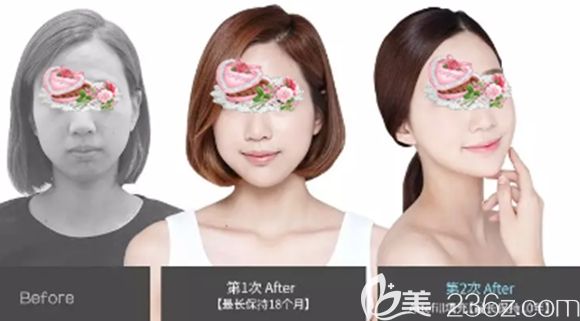 長(zhǎng)春姬安娣整形面部輪廓注射塑形案例效果圖