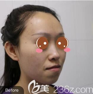 <!--<i data=20240703-sp></i>-->仁愛(ài)孫宇韓式小翹鼻+假體隆下巴真人案例術(shù)前照 <!--<i data=20240703-sp></i>-->仁愛(ài)孫宇韓式小翹鼻+假體隆下巴真人案例術(shù)前照