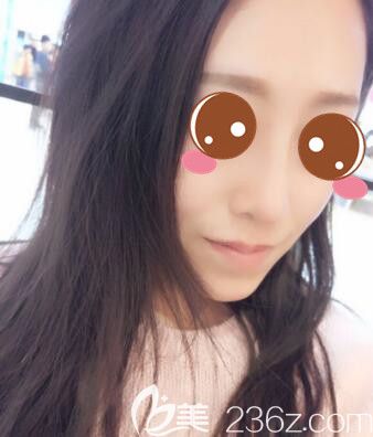 <!--<i data=20240703-sp></i>-->仁愛(ài)孫宇韓式小翹鼻+假體隆下巴真人案例術(shù)后30天 <!--<i data=20240703-sp></i>-->仁愛(ài)孫宇韓式小翹鼻+假體隆下巴真人案例術(shù)后30天