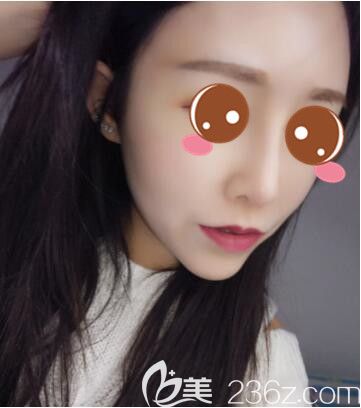 閨蜜找孫宇做的雙眼皮效果好，我找他做韓式小翹鼻+假體隆下巴價(jià)格親民效果也自然