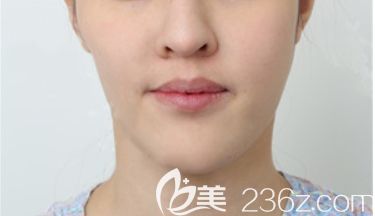 長春姬安娣整形面部輪廓整形術(shù)前照 長春姬安娣整形面部輪廓整形術(shù)前照