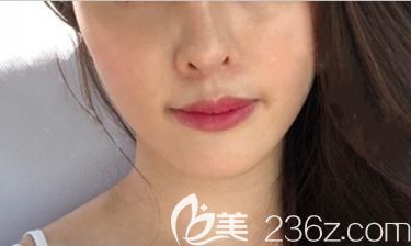 長春姬安娣整形做顴骨縮小術(shù)和下巴整形術(shù)后1個月照 長春姬安娣整形做顴骨縮小術(shù)和下巴整形術(shù)后1個月照