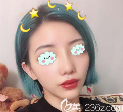 臺(tái)州藝星王波隆鼻失敗修復(fù)案例