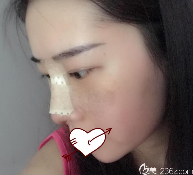 合肥藝星整形軟骨隆鼻第3天圖