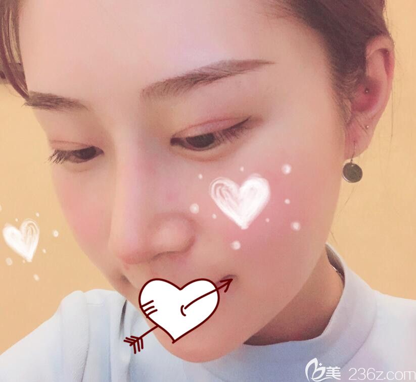 藝星整形肋軟骨隆鼻術后13天恢復情況