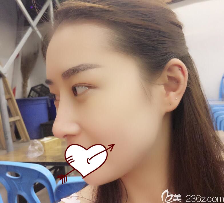 肋軟骨鼻綜合術后40天