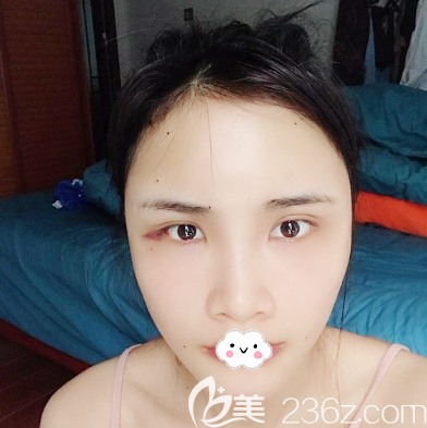 全臉自體脂肪填充術(shù)后4天恢復(fù)圖片