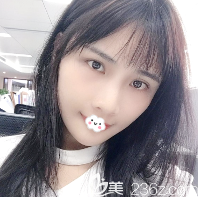 看深圳非凡全臉脂肪填充案例術(shù)后15天效果怎么樣